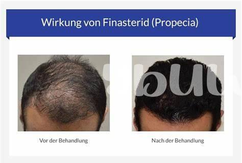 Was Ist Propecia (finasterid)?